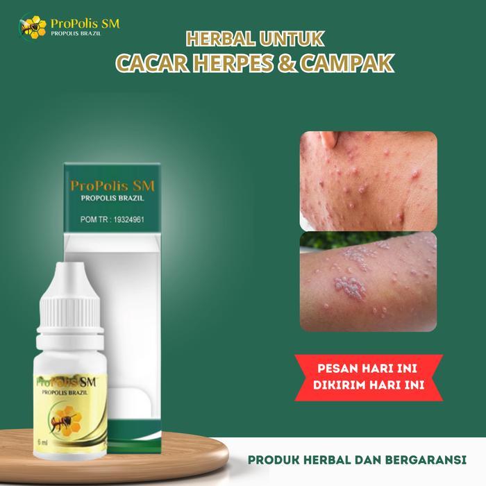 Pembersih Cacar Air Anak Dewasa Penghilang Bekas Cacar Tampek Cacar Api Kulit Bintik Berair Herpes