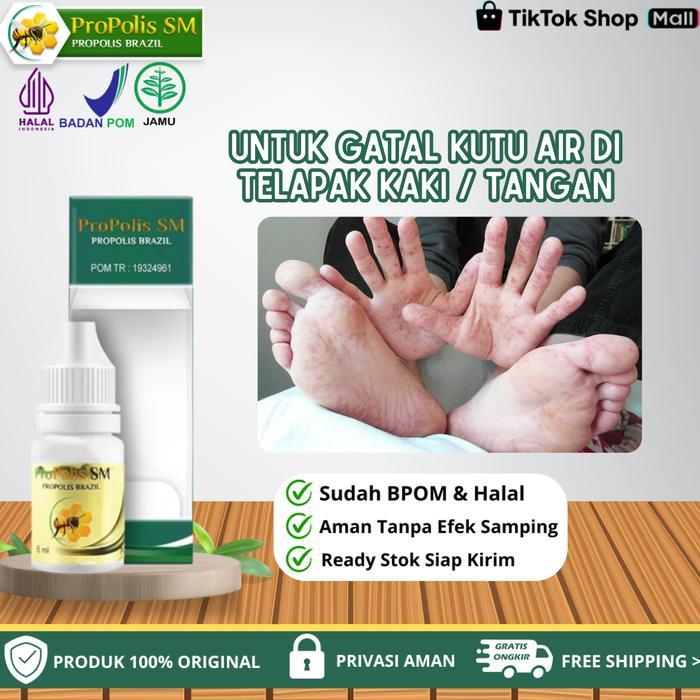PROMO Propolis SM - Untuk Gatal Kutu Air Di Sela Jari Kaki Dan Telapak Kaki, Gatal Ruam Berisi