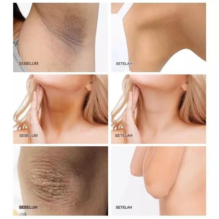 CREAM PEMUTIH KETIAK MEMUTIHKAN SELANGKANGAN HITAM PEMUTIH LEHER HITAM MEMBANDEL PEMUTIH LUTUT DAN