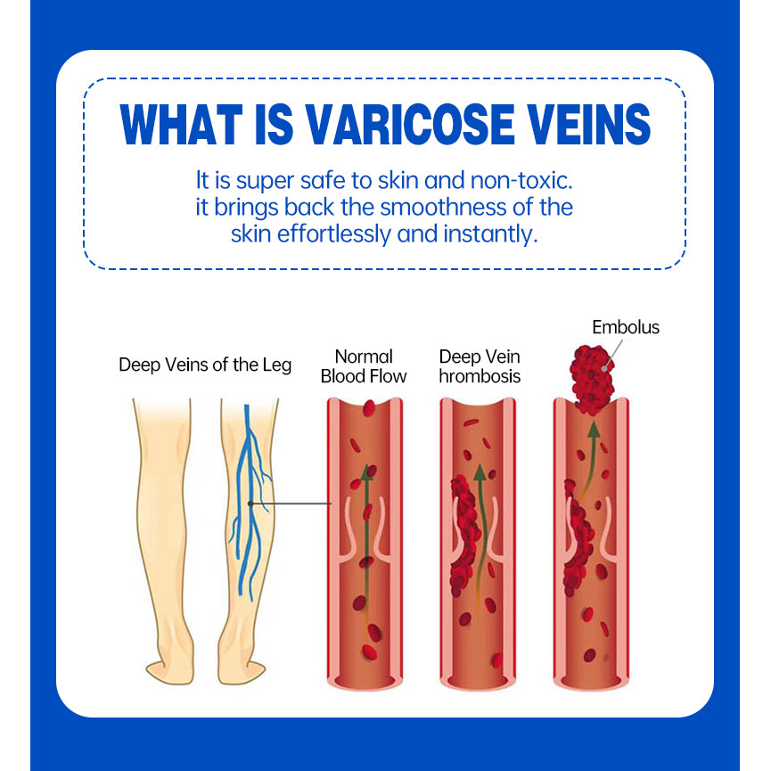 Spider blood vessels varicose veins Effective varicose vein relief cream to relieve vasculitis phleb