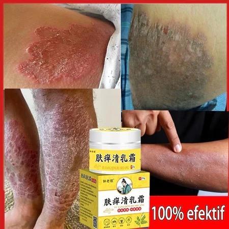 Salep China Gatal Paling Ampuh Salep Eksim Kering Dan Gatal Salep Bayi Untuk Kulit Iritasi Obat