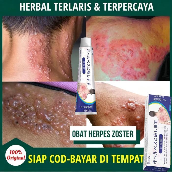 READY Krim Gatal Ampuh / Cream Gatal Eksim / Krim Psoriasis Cream Gatal Krim Kutil Cream Gatal Krim