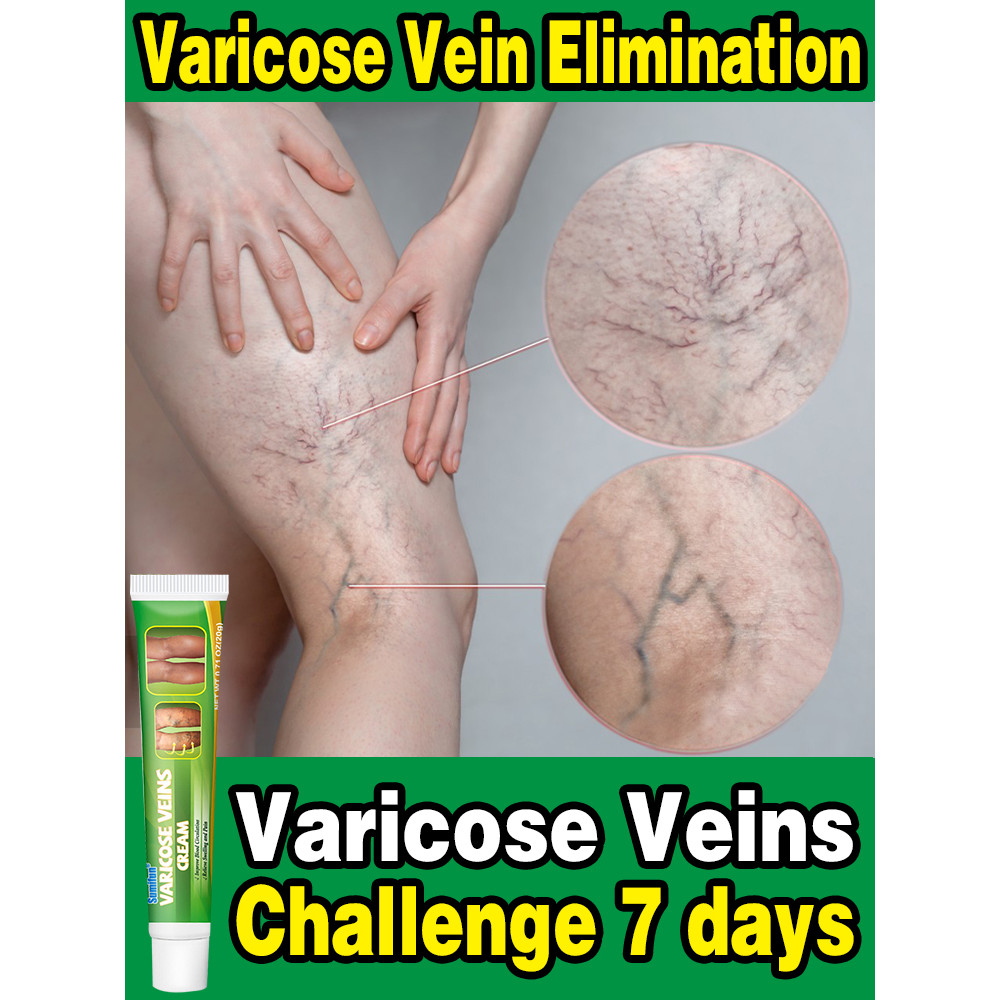 Effective Varicose Vein Relief Cream Ointment For Varicose Veins To Relieve Vasculitis Phlebitis Spi