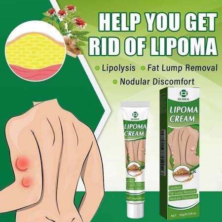 READY OUHOE Lipoma Cream Obat Benjolan Subkutan Lipoma Removal Cream Obat Salep Benjolan Lipoma