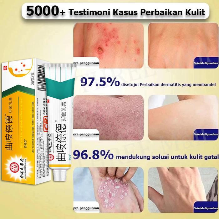 Salep Gatal China Paling Ampuh Salep Gatal Jamur Selangkanga Krim Eksim Bayi Dan Anak Obat Gatal