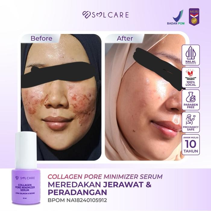 6a5g- Solcare Collagen Pore Minimizer Serum + Dna Salmon & Biome Serum Penghilang Bopeng &