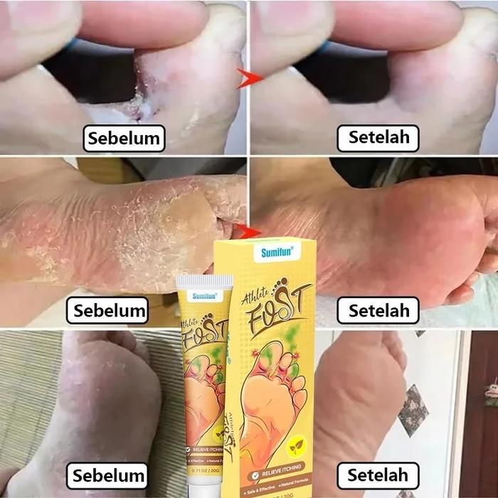Salep Gatal Kaki Ampuh Hilangkan Jamur Bau Kaki Dan Gatal Berlebih Aman Dan Cepat Sembuh Salep