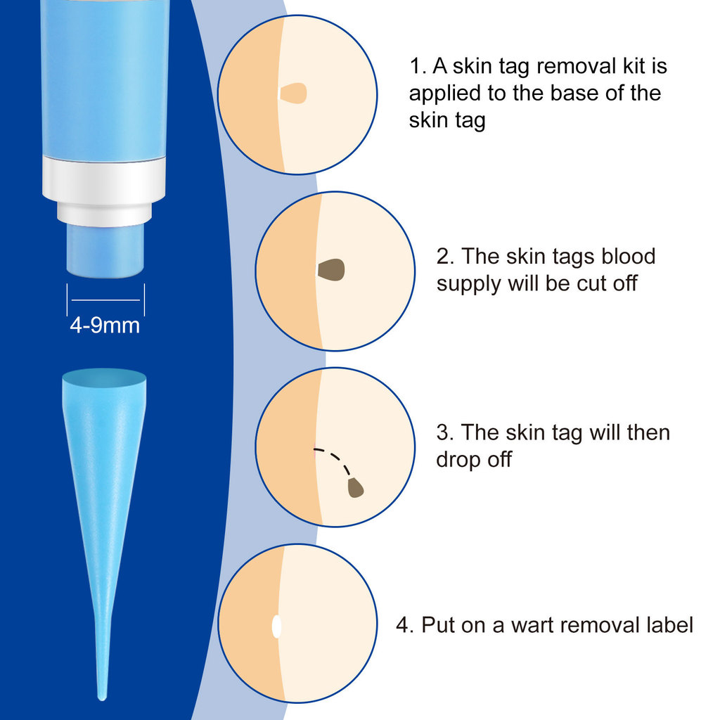 Auto Large Size Skin Tag Removal Kit For Large Skin Tags 49mm With leansing Sbs Home Use Fae Skin