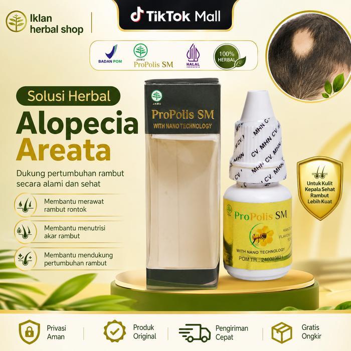 Perawatan Untuk Alopecia Areata, Rambut Pitak, Penumbuh Rambut Rontok , Psoriasis Kulit Kepala