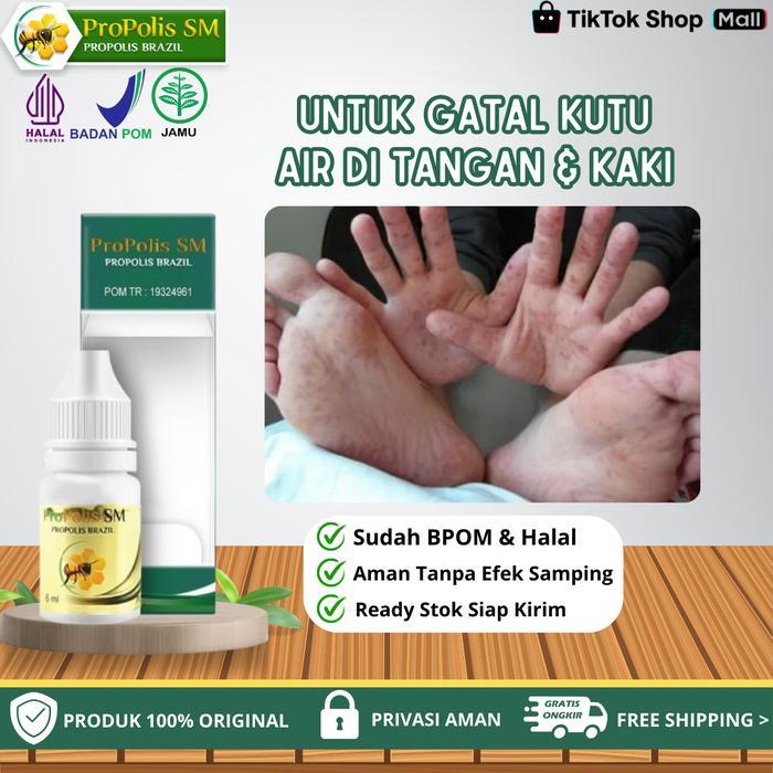 PROMO Propolis SM - Untuk Gatal Kutu Air Di Telapak Tangan / Telapak Kaki, Gatal Jamur Berair Dan