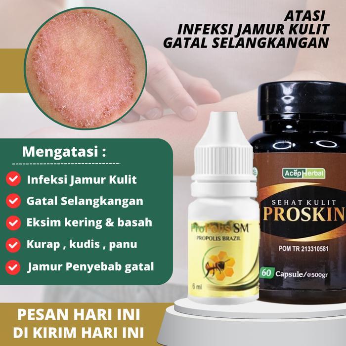 Salep Penghilang Bekas Luka Penghilang Luka Hitam Menghilangkan Luka Koreng Penghilang Koreng Di