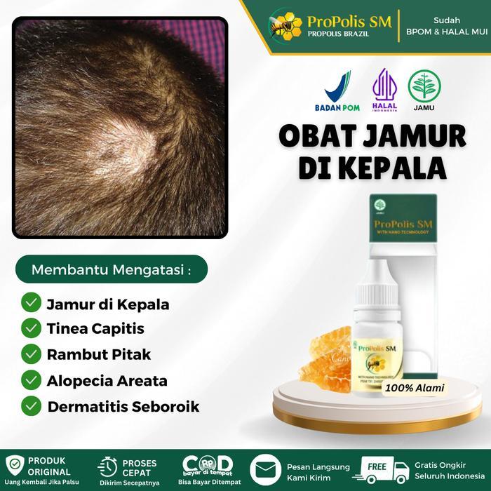 Propolis Sm - Salep Oles Untuk Jamur Di Kulit Kepala, Tinea Capitis, Dermatitis Seboroik, Rambut