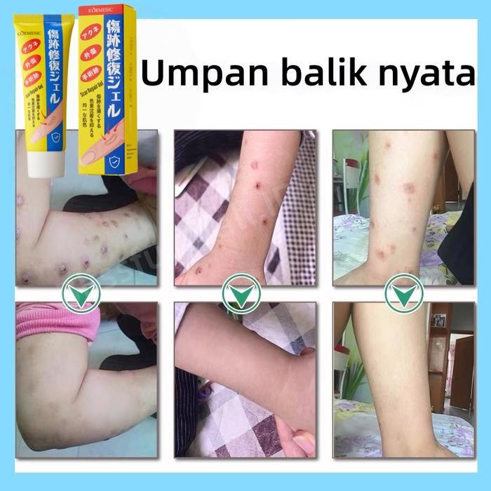 Penghilang bekas luka hitam koreng Penghilang bekas luka di kaki Penghilang Bekas luka bakar Bekas