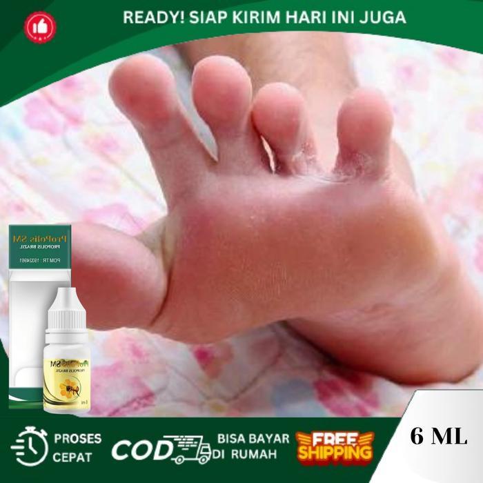PROMO Kutu Air, Kuman Air, Penghilang Kutu Air, infeksi Jamur DiKaki, Penghilang Kuman Air, Kutu
