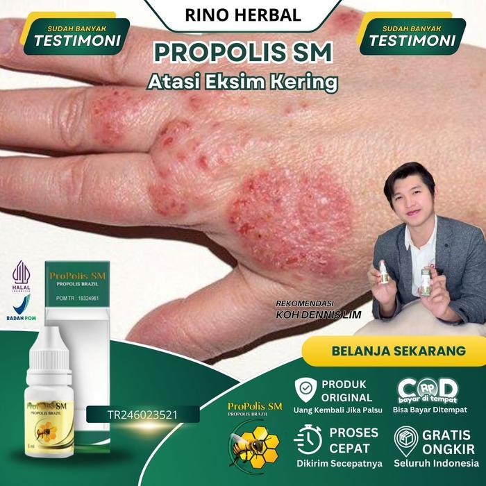 Obat Eksim, Obat Gatal Eksim, Obat Gatal Exim Kering Menahun, Obat Untuk Gatal2 Kering, Obat Gatal