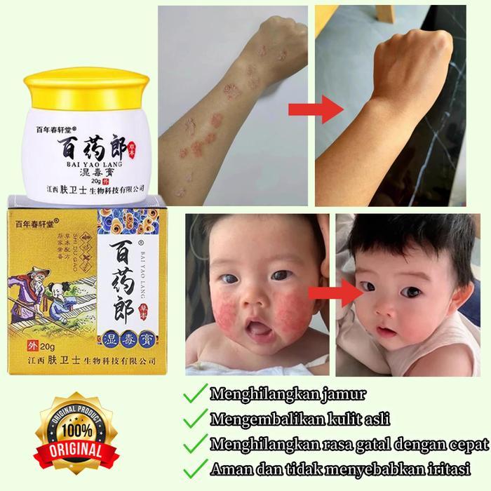 Salep Gatal China Paling Ampuh Salep Gatal Jamur Selangkanga Krim Eksim Bayi Dan Anak Obat Gatal