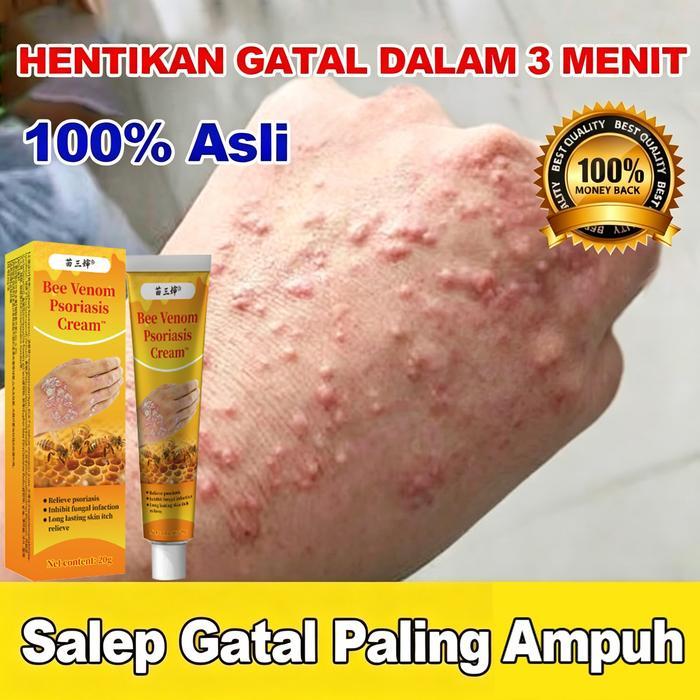 Salep Eksim Kering Dan Gatal Salep Gatal Paling Ampuh Obat Gatal Selangkangan Salep Bayi Untuk Kulit