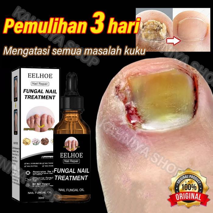 Obat Jamur Kuku Perawatan Kuku Obat Kuku Jamur Dan Rusak Penghilang Jamur Kuku Obat Infeksi Kuku