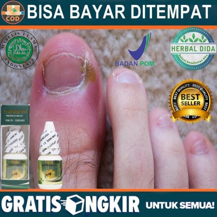 Cantengan, Kuku Cantengan, Jamur Kuku, Propolis Sm