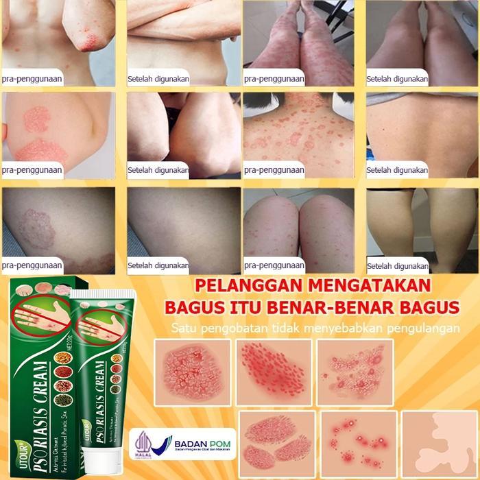 Krim Gatal Paling Ampuh Krim Psoriasis Krim Gatal 20G Krim Gatal Selangkangan Psoriasis Psoriasis