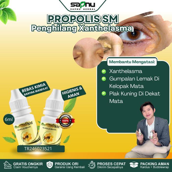 Propolis sm Untuk Xanthelasma Penghilang Gumpalan Lemak Di Kelopak Mata