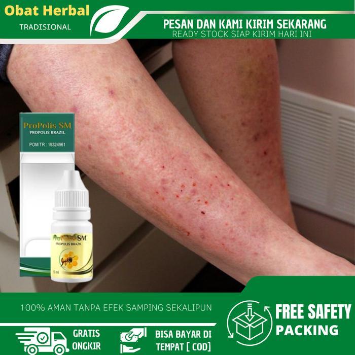 Perawatan Untuk Mengatasi Alergi Semen, Dermatitis Kontak, Kulit Lecet dan Melepuh, Gatal Alergi