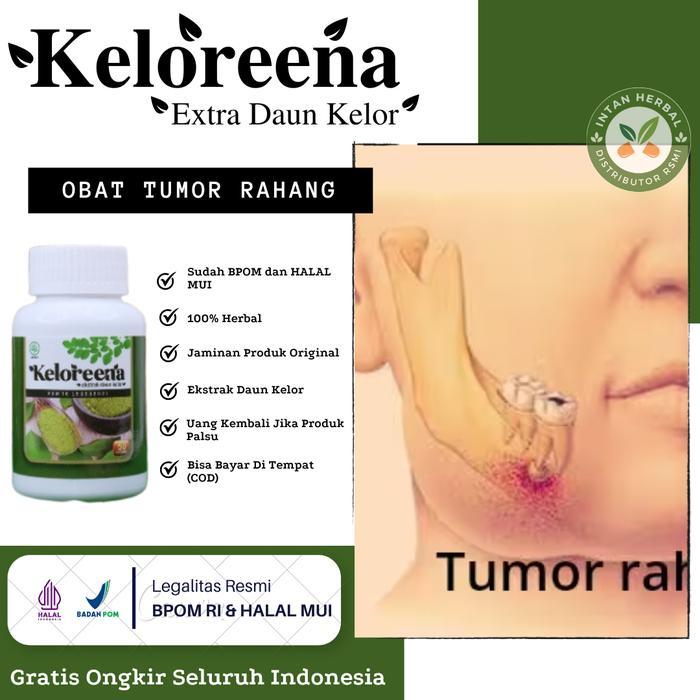 Keloreena Mengatasi Tumor Rahang Bengkak, Benjolan Gusi Dalam Mulut, Kanker Rahang Atasi Dengan Kelo