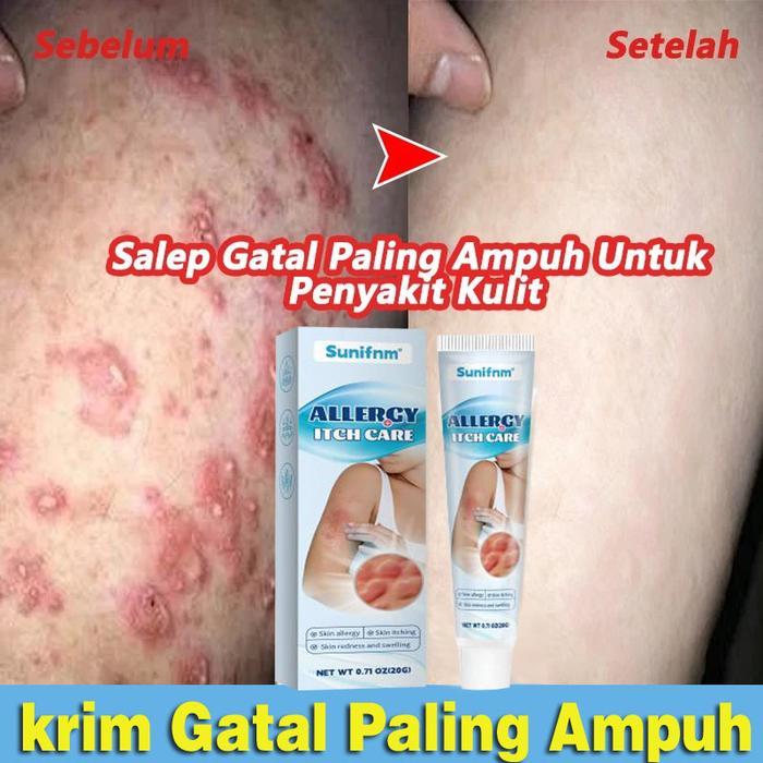 READY krim gatal paling ampuh krim Oles Gatal, Ruam, dan Iritasi Kulit Anti jamur krim krim gatal