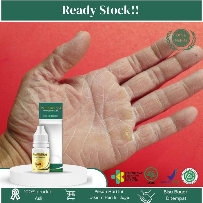 Oles Kulit Jari Tangan Kering, Kulit Jari Mengelupas, Telapak Tangan Kasar, Kulit Jari Pecah Pecah,