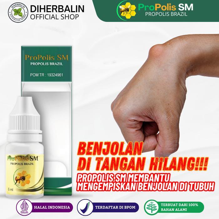 ProPolis SM Obat Kista Ganglion Benjolan Di Tangan