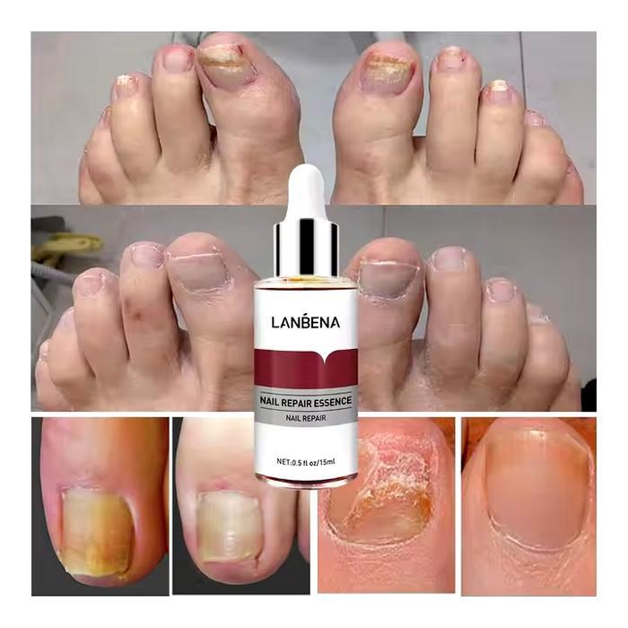 LANBENA NAIL REPAIR ESSENCE OIL SERUM NAIL TREATMENT