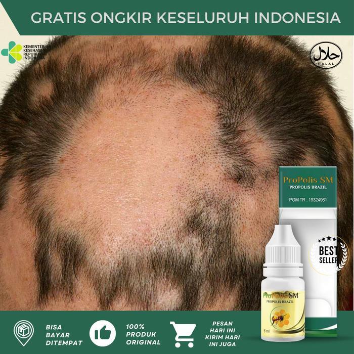 Alopecia Areata, Salep Pitak, Botak Koin, Penumbuh Rambut Botak, Kebotakan Rambut Pada Kepala,