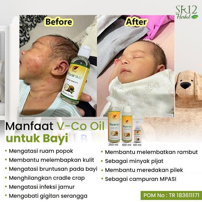 Vco Untuk Bayi/ Minyak Untuk Bayi/ Ruam Popok Bayi/ Obat Gatal Bayi