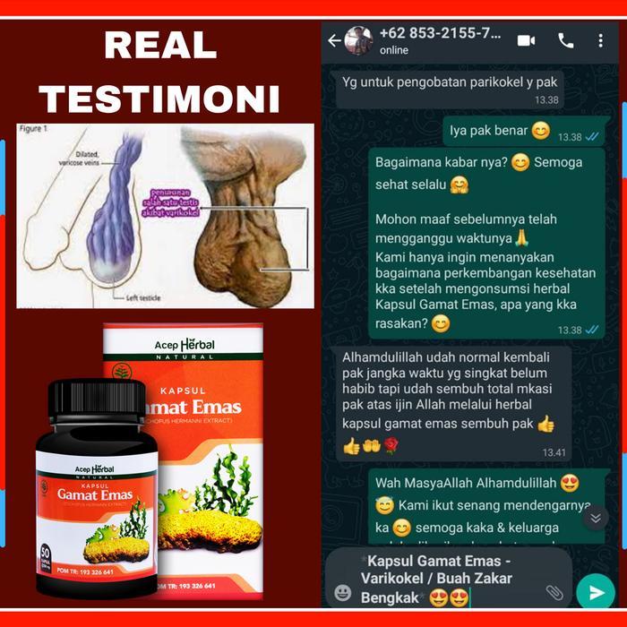 OBAT VARIKOKEL TERBUKTI! MANDUL SPERMA ENCER VARISES PADA BUAH ZAKAR BENGKAK