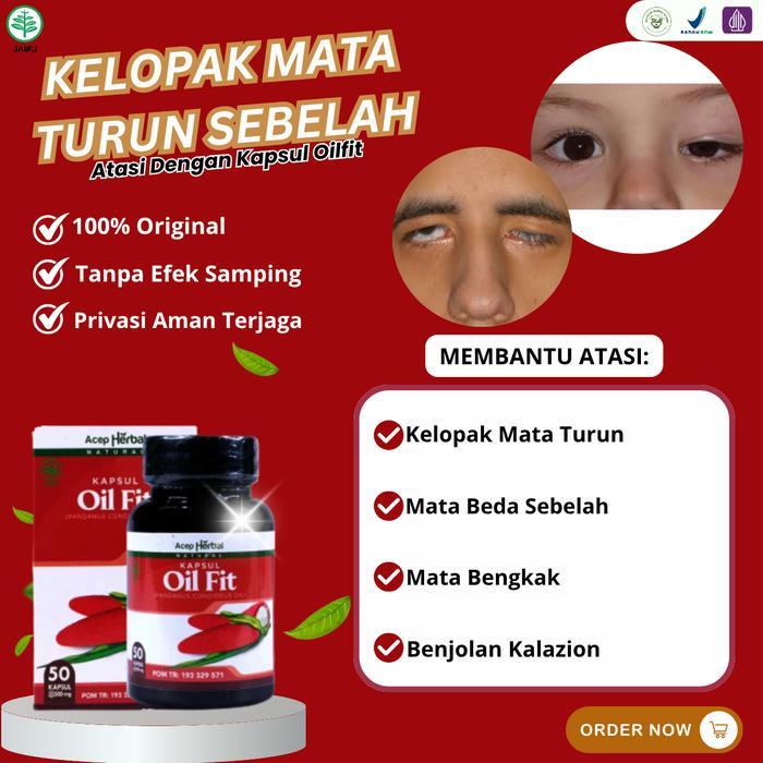 Oiflit Untuk Atasi Mata Ptosis Lipatan Kelopak Mata Turun Sebelah Mata Sipit Sebelah Kelopak Mata