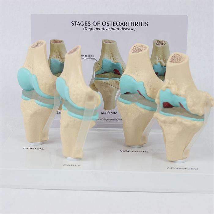 KNEE KIT OSTEOARTHRITIS ANATOMY MODEL WITH EDUCATIONAL KEY CARD 4 STAGE KNEE MODEL ORTHOPEDIC