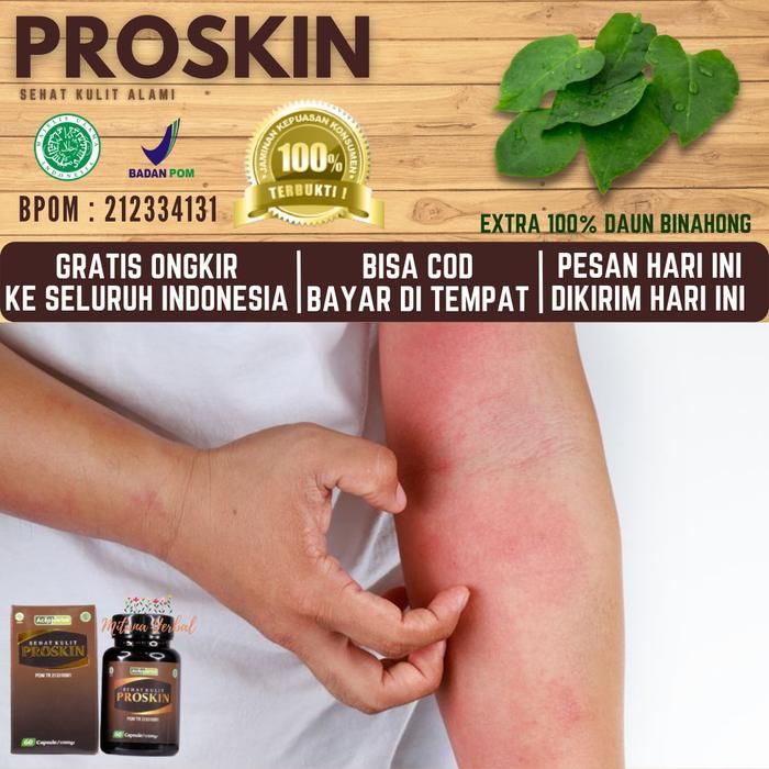 Obat Kudis Kurap Gatal, Gatal Alergi, Gatal Eksim, Gatal Menahun