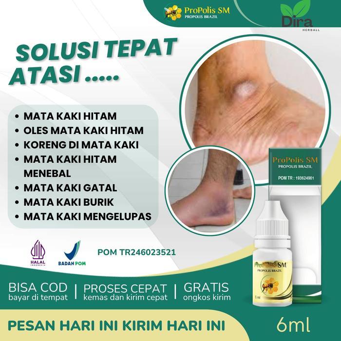 Propolis Sm Herbal Untuk Mata Kaki Hitam, Pemutih Mata Kaki Yang Hitam, Koreng Di Mata Kaki, Mata