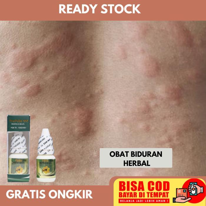 OBAT ALERGI DINGIN, BIDURAN, KALIGATA, KULIT GATAL, ANAK DAN DEWASA