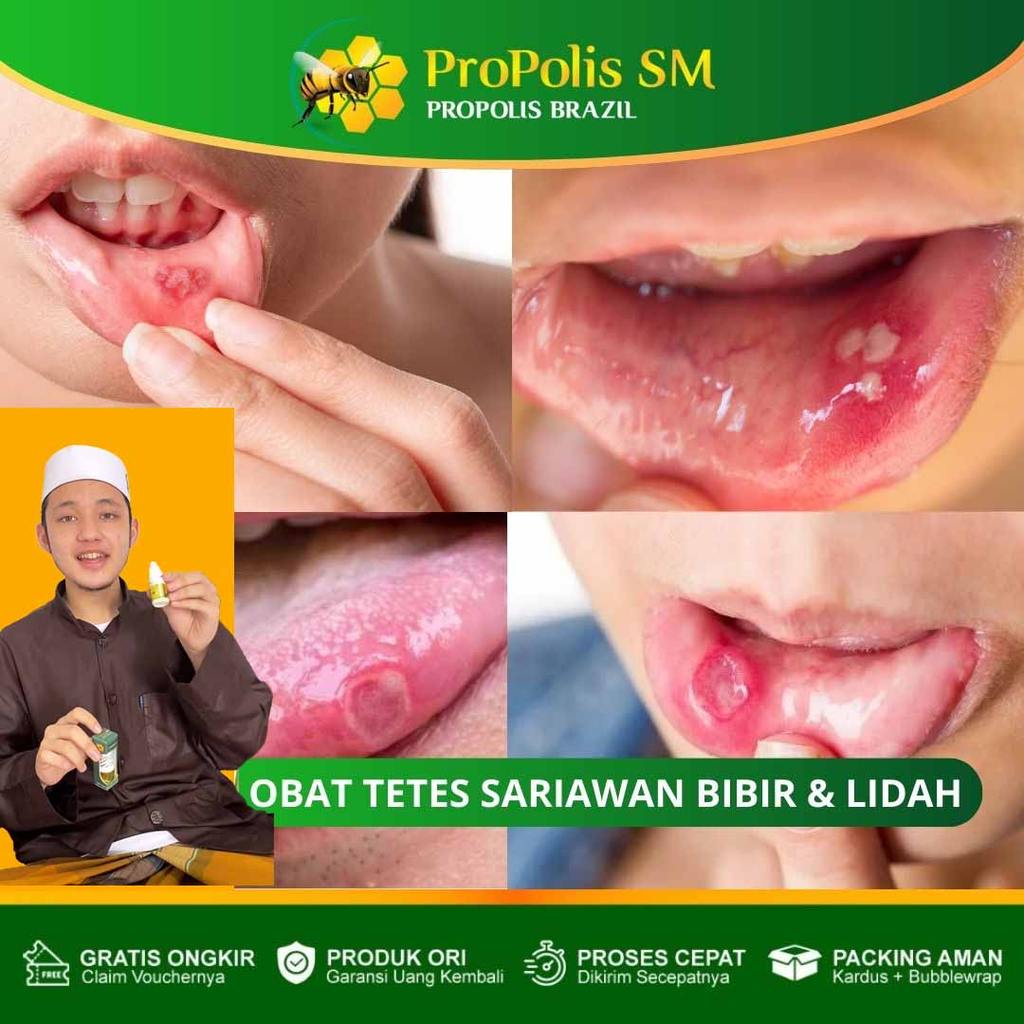 PROPOLIS SM  Obat Sariawan di Bibir Bengkak, Luka Sariawan Menganga, Bibir Perih Nyut-nyutan, Panas 