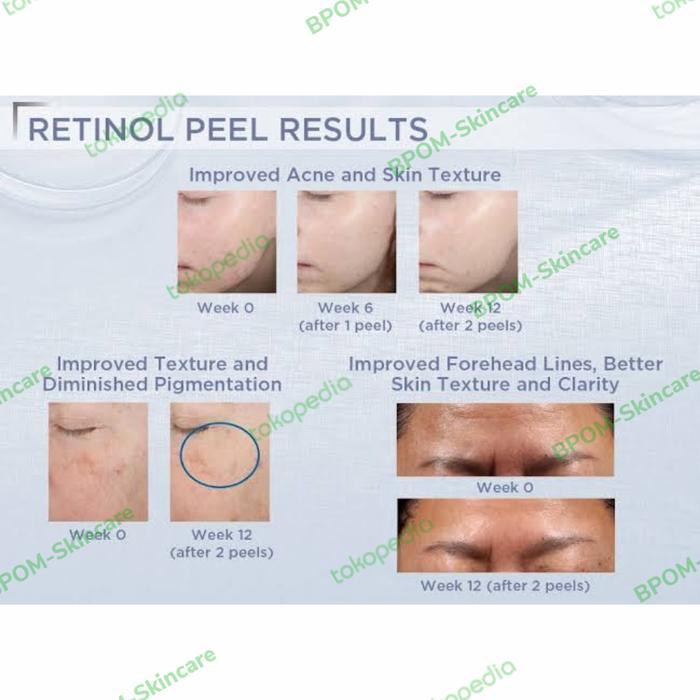 Neostrata Prosystem Retinol Peel 3% Brightening Antiaging Peeling Usa