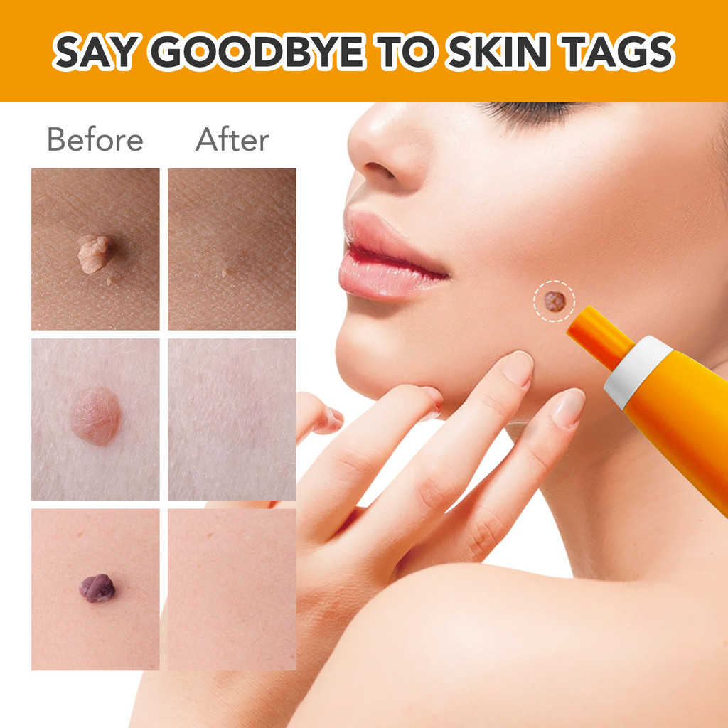 Micro Skin Tag Remover Auto Wart Removal Kit Cleaning Skin Tag Removal Mole Removal Machine Body