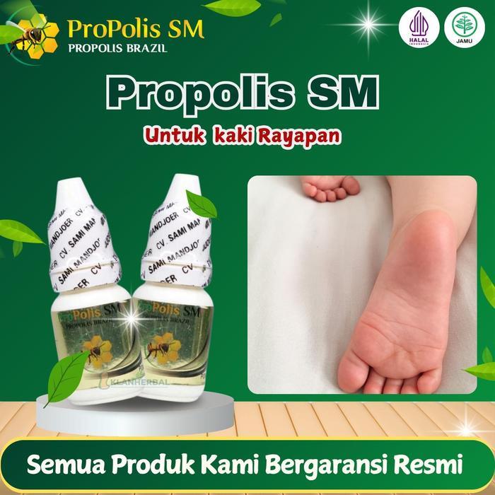 Atasi Kaki Rayapan, Kaki Berlubang, Pitted Keratolysis, Rorombeheun, Kaki Bolong Bolong Dengan