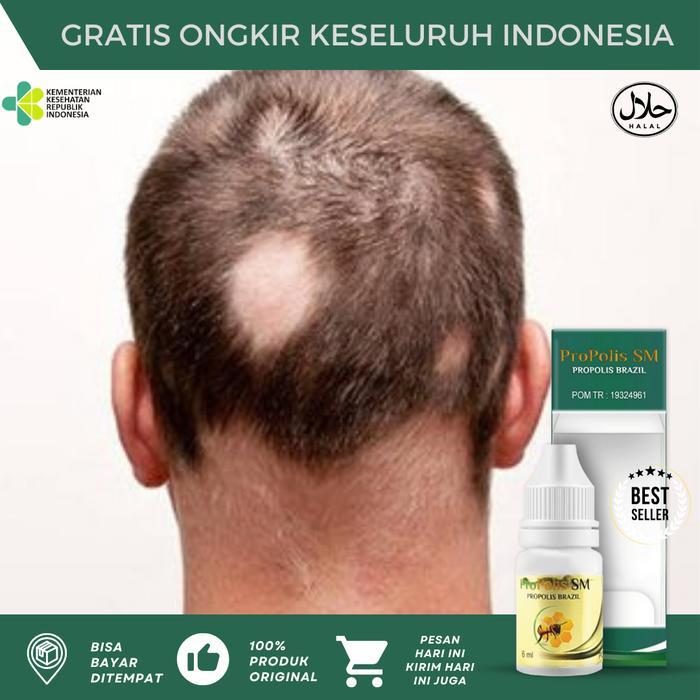 Alopecia Areata, Penumbuh Rambut Pitak, Penumbuh Botak Koin, Penumbuh Rambut Pitak, Botak Koin,