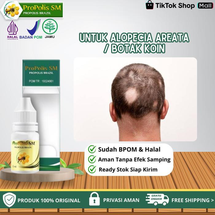 Propolis SM - Untuk Alopecia Areata / Kebotakan Rambut / Rambut Rontok / Botak Koin, Penumbuh Rambut