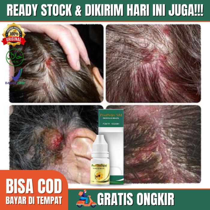 Obat Ketombe Rambut Berkerak Bersisik Koreng Obat Kulit Kepala Koreng