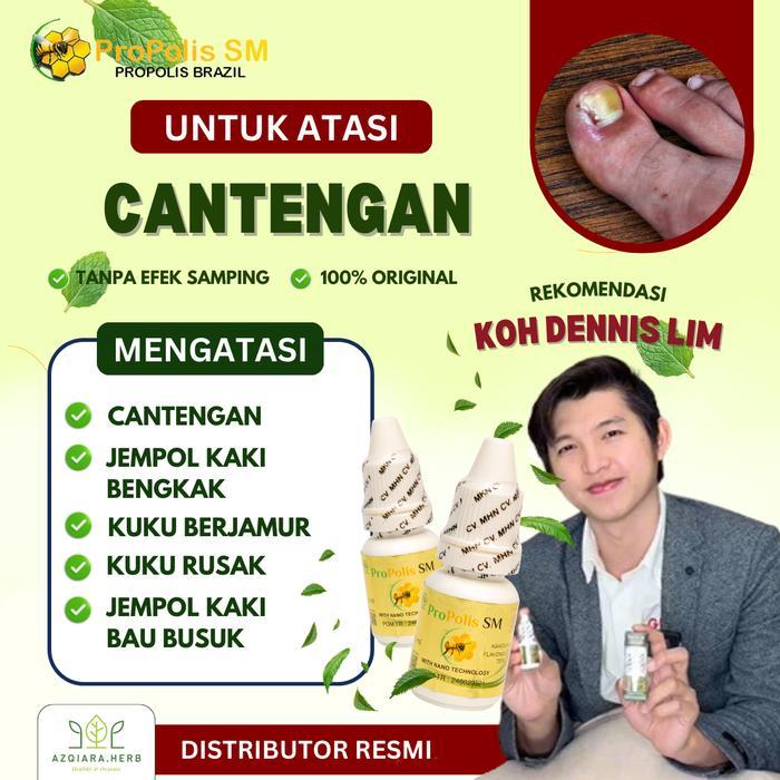 Propolis Sm Tetes Kaki Cantengan, Cantengan Bernanah, Cantengan Di Jempol Kaki, Tetes Jempol Kaki