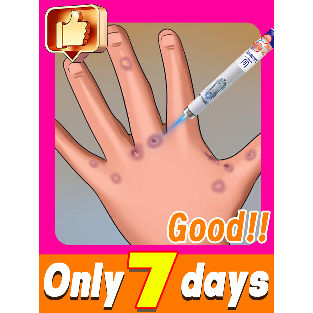 Skin Care Blue Light Wart Tool Effective to Use Ls Ws R