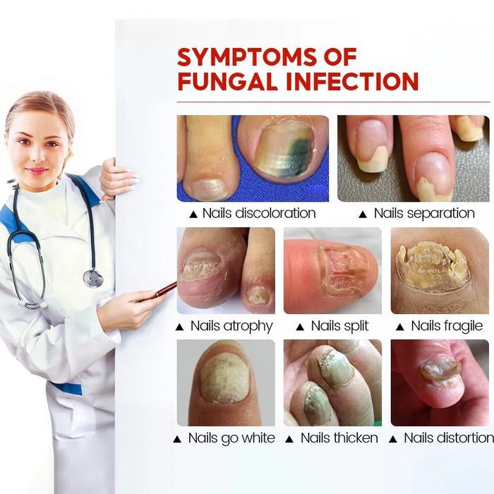 OBAT JAMUR KUKU PERAWATAN KUKU OBAT KUKU JAMUR DAN RUSAK PENGHILANG JAMUR KUKU OBAT INFEKSI KUKU