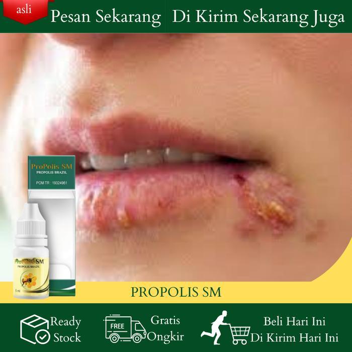 Cairan Oles Penghilang Herpes Bibir Bintik Bintik Putih Di Bibir, Bibir Gatal